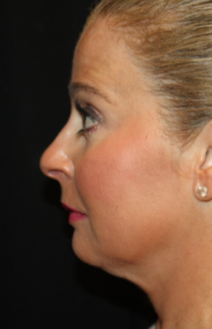 Kybella Before & After Patient #19809