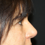 Rhinoplasty Before & After Patient #21671