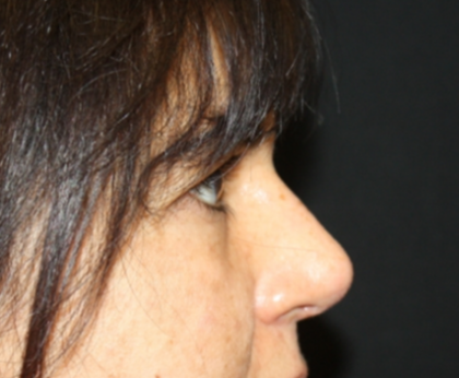 Rhinoplasty Before & After Patient #21671