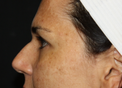 Rhinoplasty Before & After Patient #21671