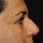 Rhinoplasty Before & After Patient #21671