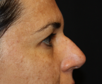 Rhinoplasty Before & After Patient #21671