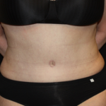 Liposuction Before & After Patient #23232