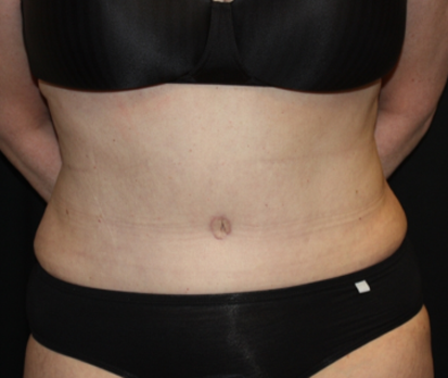 Liposuction Before & After Patient #23232