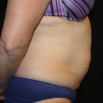 Liposuction Before & After Patient #23232