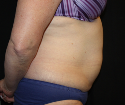 Liposuction Before & After Patient #23232