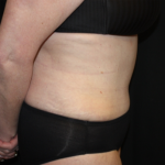 Liposuction Before & After Patient #23232