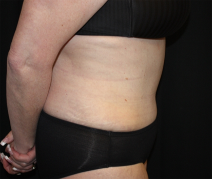 Liposuction Before & After Patient #23232