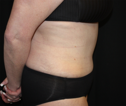 Tummy Tuck Before & After Patient #22813