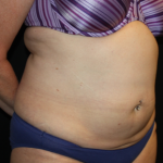 Liposuction Before & After Patient #23232