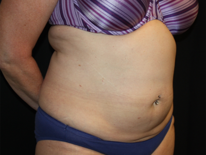 Liposuction Before & After Patient #23232