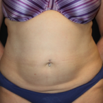 Liposuction Before & After Patient #23232