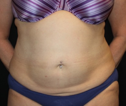 Liposuction Before & After Patient #23232