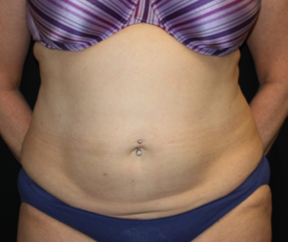 Tummy Tuck Before & After Patient #22813