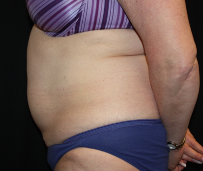 Liposuction Before & After Patient #23232