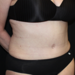 Liposuction Before & After Patient #23232