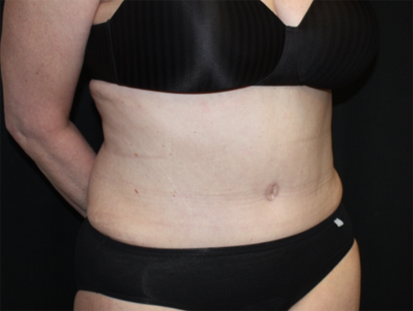 Tummy Tuck Before & After Patient #22813