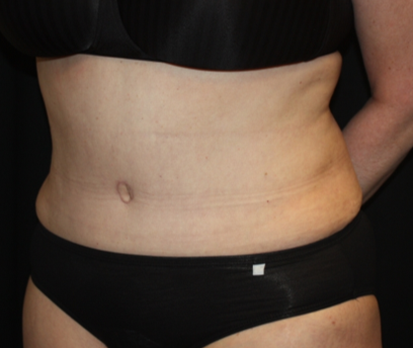 Liposuction Before & After Patient #23232