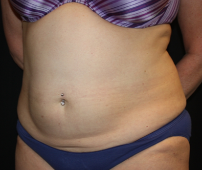 Liposuction Before & After Patient #23232