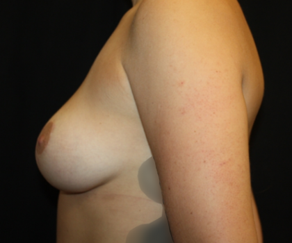 Breast Lift Before & After Patient #20955