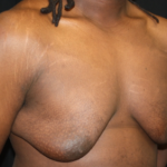 Gynecomastia Before & After Patient #21300