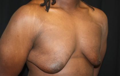 Gynecomastia Before & After Patient #21300