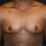 Gynecomastia Before & After Patient #21300