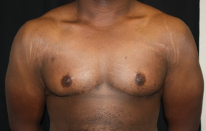 Gynecomastia Before & After Patient #21300