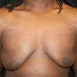 Gynecomastia Before & After Patient #21300