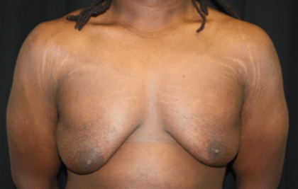 Gynecomastia Before & After Patient #21300
