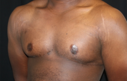 Gynecomastia Before & After Patient #21300