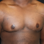 Gynecomastia Before & After Patient #21300