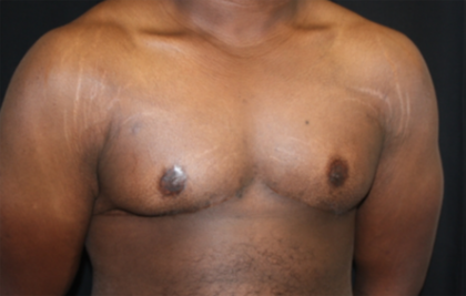 Gynecomastia Before & After Patient #21300