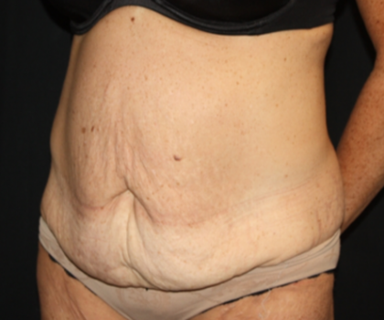 Tummy Tuck Before & After Patient #22835