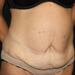 Tummy Tuck Before & After Patient #22835