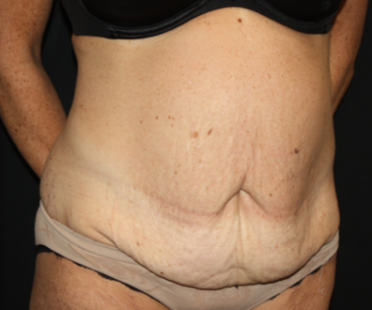 Tummy Tuck Before & After Patient #22835