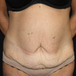 Tummy Tuck Before & After Patient #22835