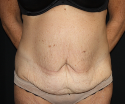 Tummy Tuck Before & After Patient #22835