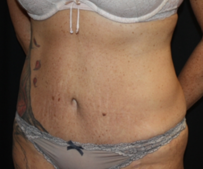 Tummy Tuck Before & After Patient #22835