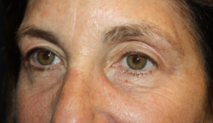 Blepharoplasty and Brow Lift Before & After Patient #20322