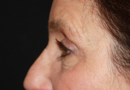 Blepharoplasty and Brow Lift Before & After Patient #20322