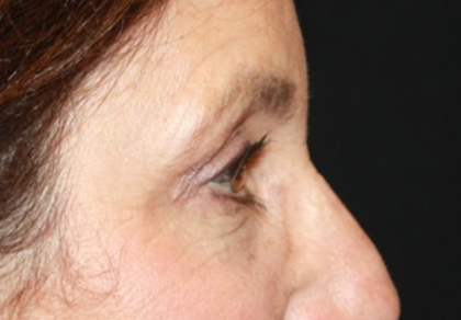 Blepharoplasty and Brow Lift Before & After Patient #20322