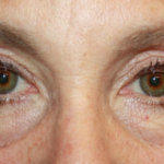 Blepharoplasty and Brow Lift Before & After Patient #20322