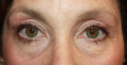 Blepharoplasty and Brow Lift Before & After Patient #20322