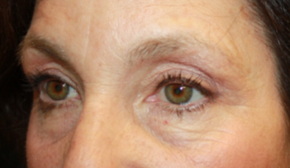 Blepharoplasty and Brow Lift Before & After Patient #20322