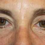 Blepharoplasty and Brow Lift Before & After Patient #20322