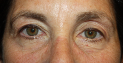 Blepharoplasty and Brow Lift Before & After Patient #20322