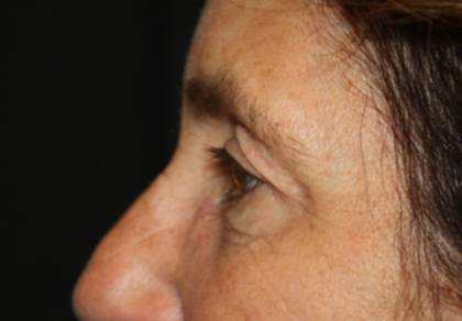 Blepharoplasty and Brow Lift Before & After Patient #20322