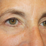 Blepharoplasty and Brow Lift Before & After Patient #20322