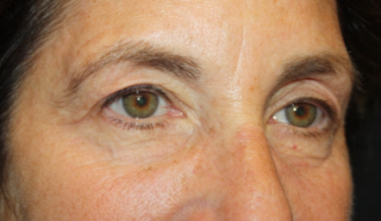 Blepharoplasty and Brow Lift Before & After Patient #20322